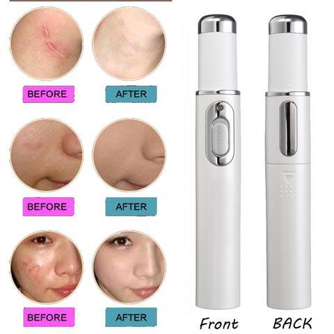 Blue Light Therapy Acne Laser Pen Soft Scar Wrinkle Removal Treatment Device Skin Care Beauty Equipment.