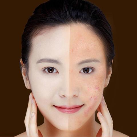 Blue Light Therapy Acne Laser Pen Soft Scar Wrinkle Removal Treatment Device Skin Care Beauty Equipment.